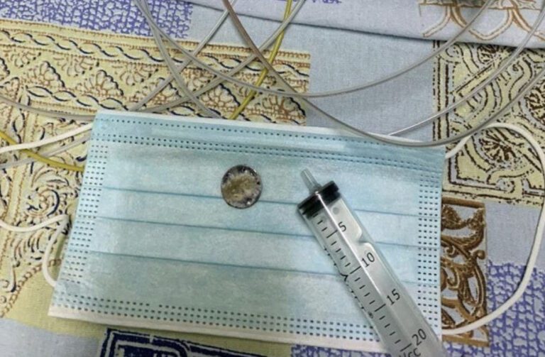 В Туапсе врачи извлекли батарейку из пищевода 3-летней девочки